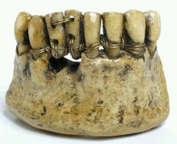 Древняя этрусская стоматология. интересное, прошлое, стоматологи, ужас, факты