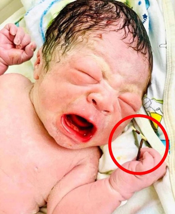 Во Вьетнаме родился ребёнок с противозачаточной спиралью в руке