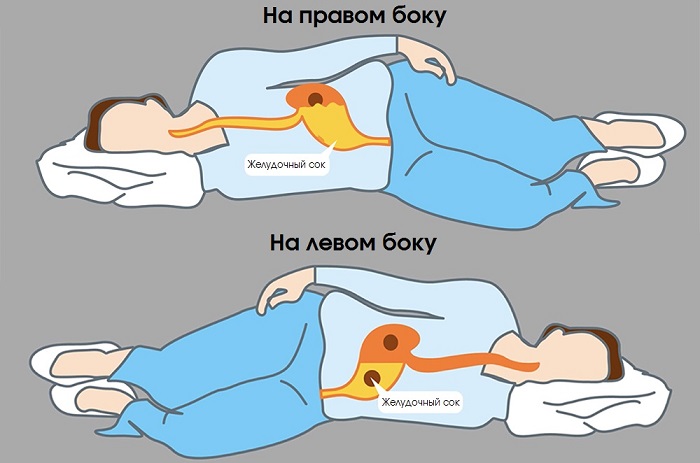 При сне на левом боку желудочный сок не попадает в пищевод. / Фото: Chtoikak.ru