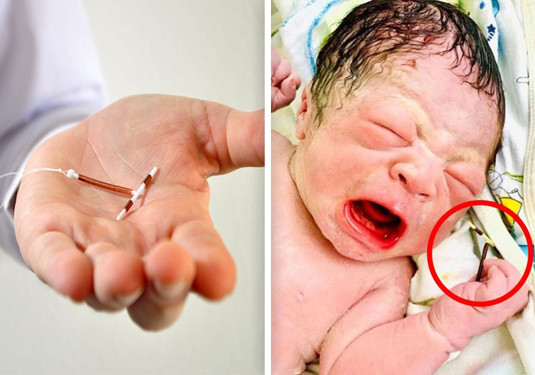 Во Вьетнаме родился ребёнок с противозачаточной спиралью в руке