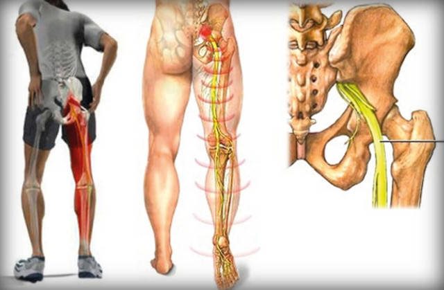 Ишиас. Защемление седалищного нерва: что нужно знать и как справиться с недугом? нерва, седалищного, защемления, нужно, может, только, можно, защемление, упражнения, воспаления, которые, теплым, маслом, лечение, поясницы, уменьшения, пленкой, лечения, приложить, время