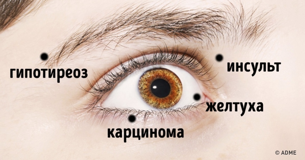 8 вещей, которые глаза пытаются сказать о вашем здоровье болезни,глаза,диагностика,здоровье