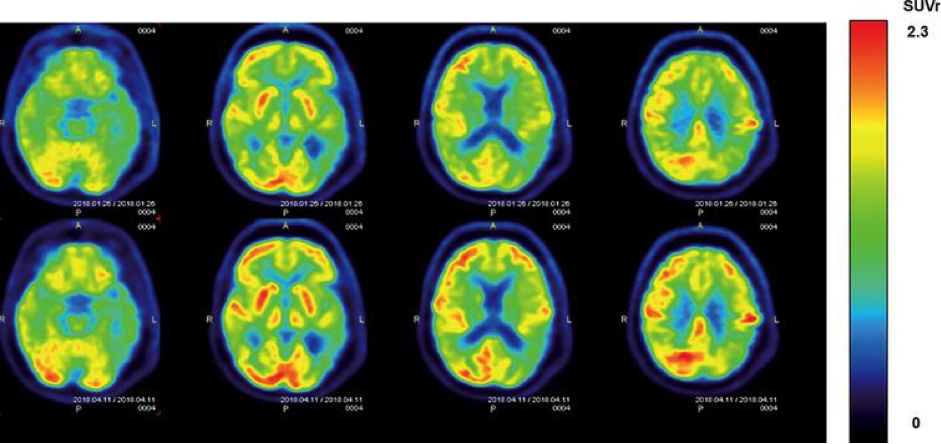 Альцгеймер мрт. Позитронно эмиссионная томография болезнь Альцгеймера. Альцгеймера болезнь ПЭТ кт. ПЭТ при болезни Альцгеймера. ПЭТ/кт головного мозга "Альцгеймера".
