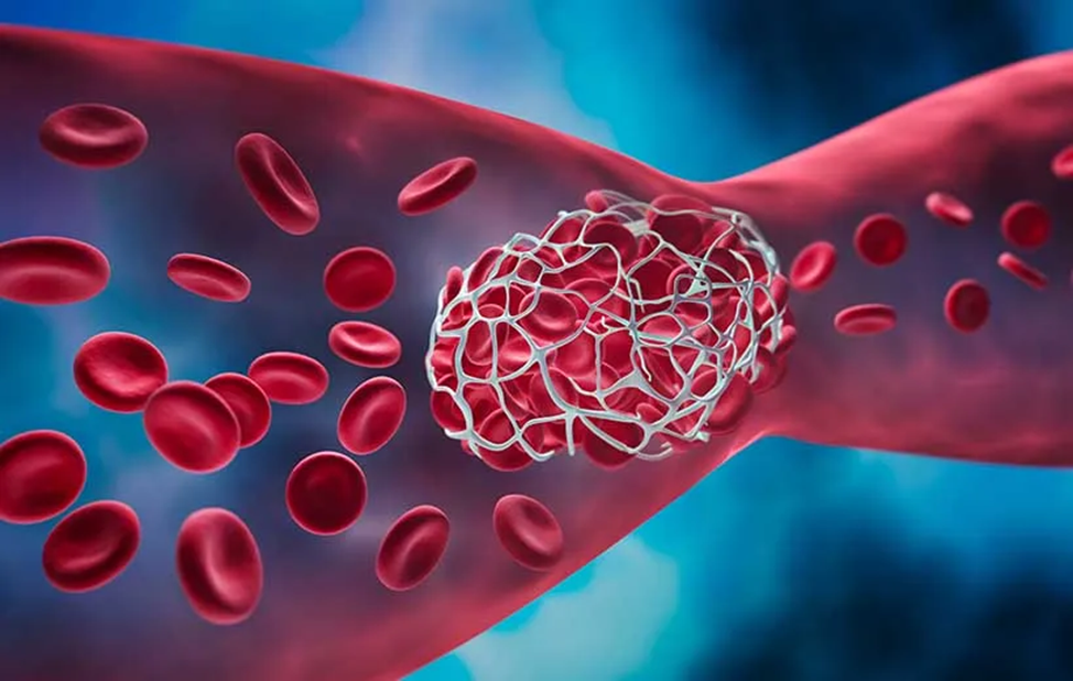 Осторожно тромб — как заметить образование тромба и спасти жизнь, если он оторвался
