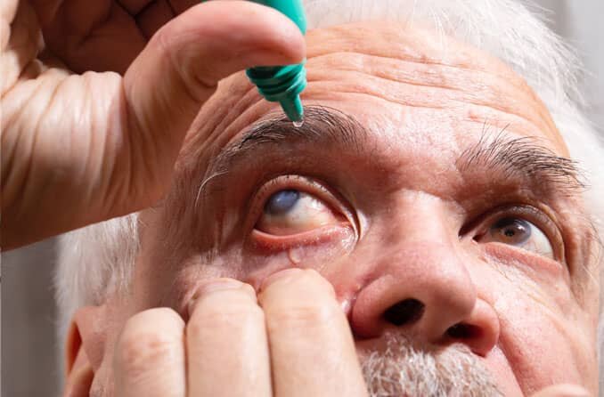 катаракта у пожилого человека