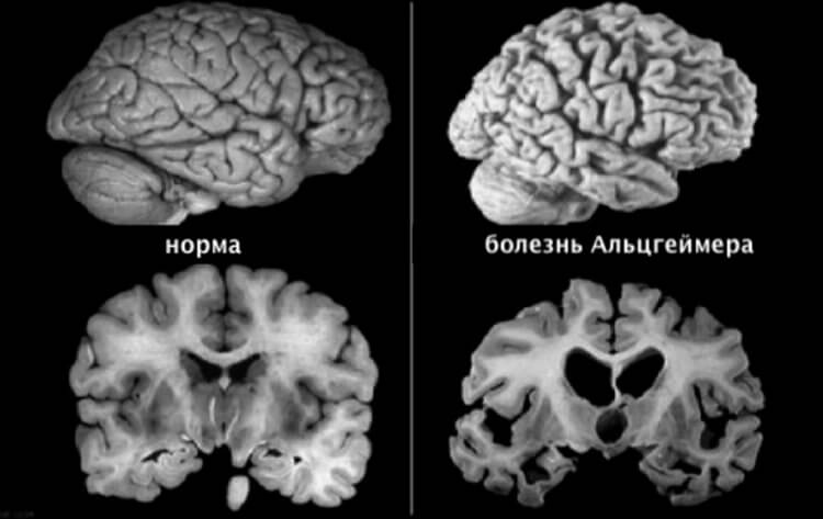 Почему женщины страдают от болезни Альцгеймера чаще, чем мужчины Альцгеймера, болезнь, накопления, человека, людей, может, которые, возникает, мозга, могут, таубелков, мозге, метки, USP11, болезни, начинает, поэтому, этого, таубелки, таубелка