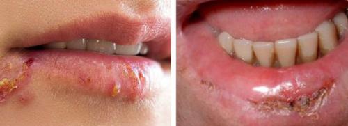 Трещины и заеды в уголках губ. Заеды. Причины, лечение, профилактика 06