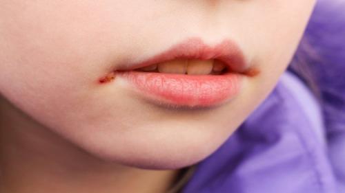 Трещины и заеды в уголках губ. Заеды. Причины, лечение, профилактика 02