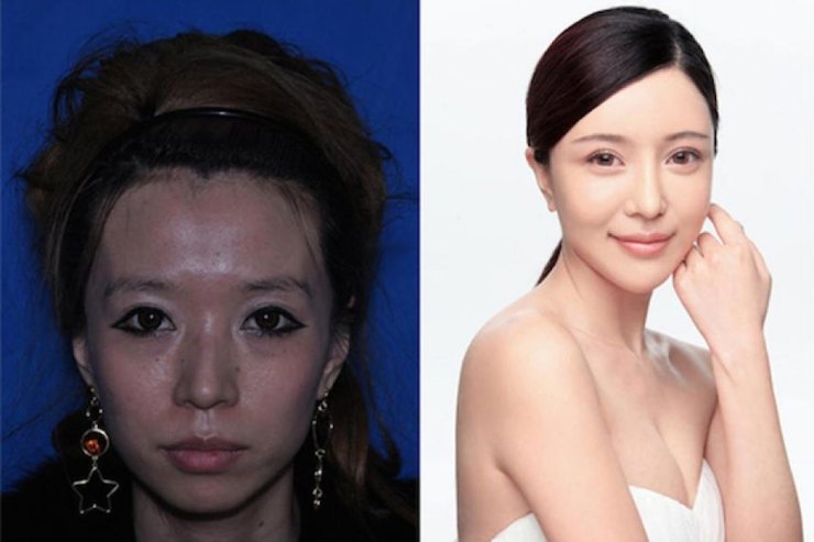 Красота по‑азиатски: какие пластические операции делают восточные девушки азия