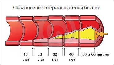 развитие атеросклероза