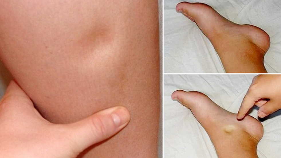 5 причин отеков. От чего случается застой жидкости?