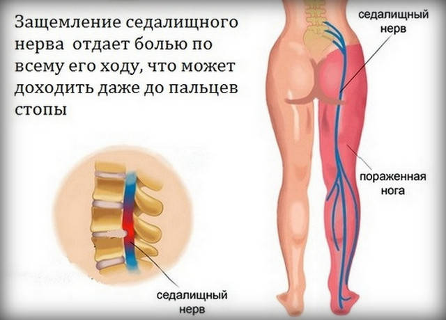 Ишиас. Защемление седалищного нерва: что нужно знать и как справиться с недугом? нерва, седалищного, защемления, нужно, может, только, можно, защемление, упражнения, воспаления, которые, теплым, маслом, лечение, поясницы, уменьшения, пленкой, лечения, приложить, время