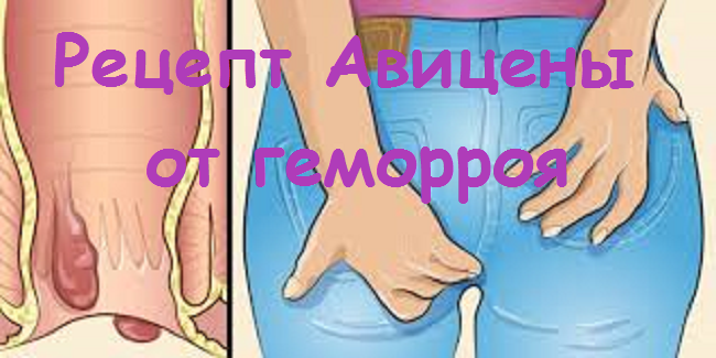 Наружный бывает и внутренний. Только боли при обоих одинаковые.