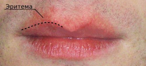 Трещины и заеды в уголках губ. Заеды. Причины, лечение, профилактика 05