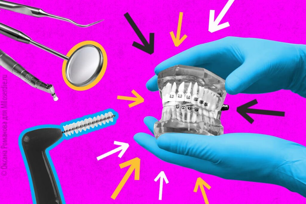 15 вопросов о брекетах, ответы на которые лучше знать заранее брекеты,зубы,ортодонтия,прикус,стоматология