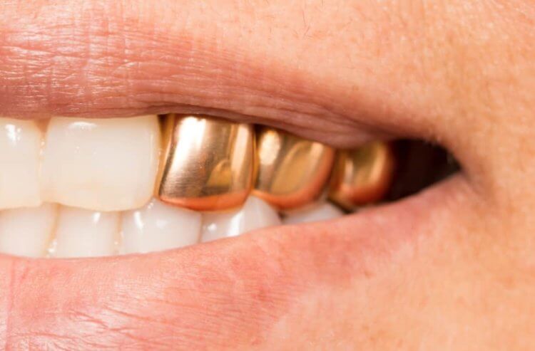 Почему во времена СССР были популярны золотые зубы