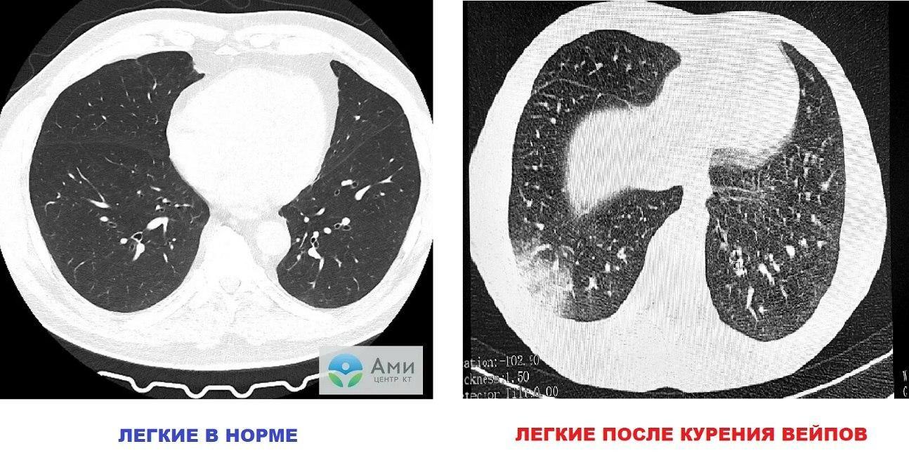 В России растет число вейперов с «попкорновой болезнью»: что это за инфекция и как ее диагностировать EVALI, легких, вейпа, больше, легкие, вейперов», повреждение, подростков, человек, возникает, болезни, именно, курением, людей, России, между, курении, встречаются, бактерии, человека