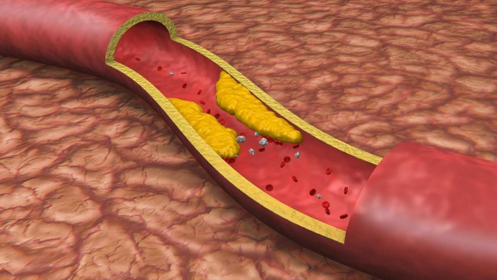 Образование холестериновых бляшек