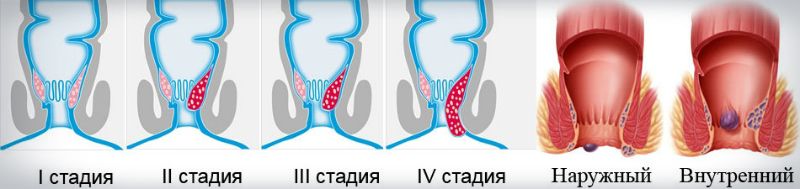 наружный и внутренний геморрой