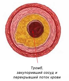 третья стадия - тромб полностью перекрыл суженый сосуд