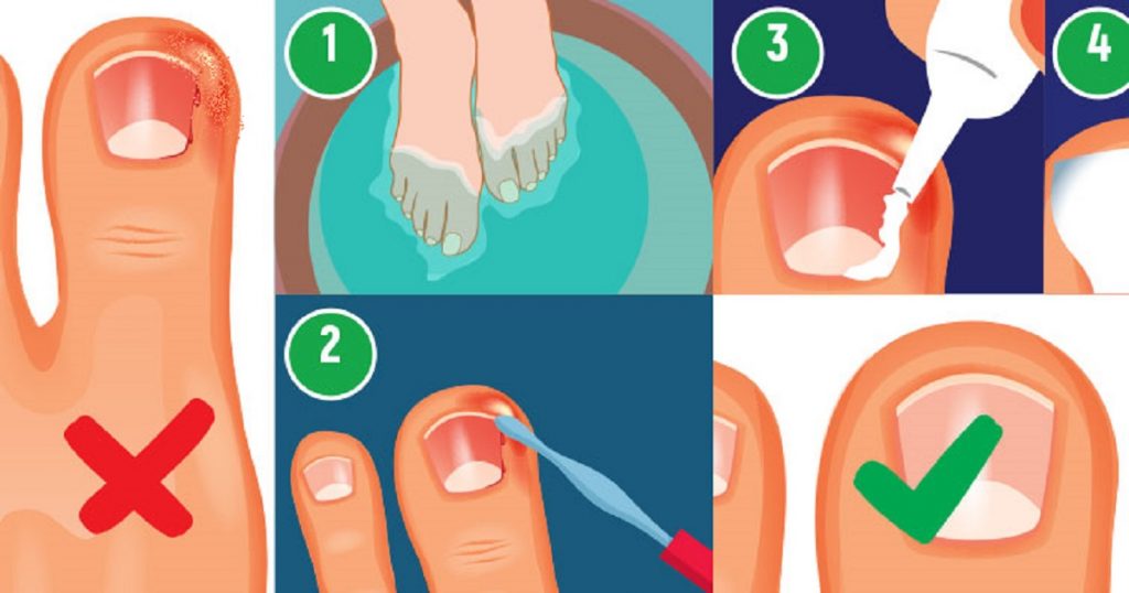 Как обрезать вросший ноготь в палец