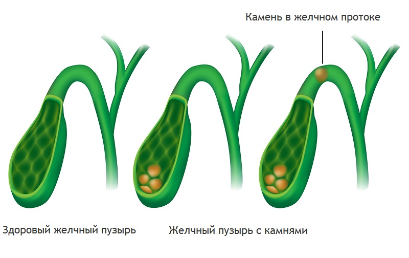 Желчнокаменная болезнь