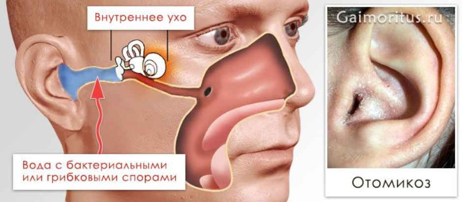 Как избавиться от грибка и зуда в ушах