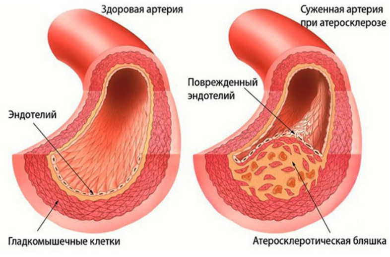 Очень эффективное средство очистки сосудов: этот рецепт очень действенный. Результат - всегда положительный!