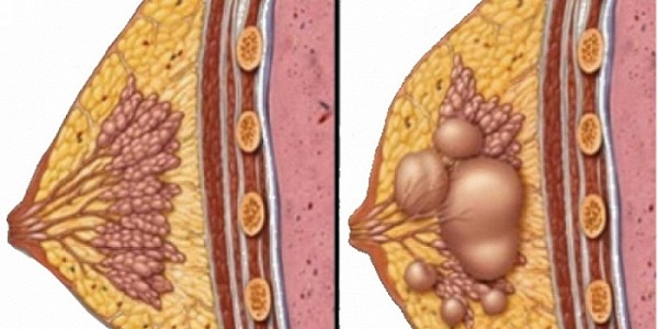 Вы не должны ложиться под нож: Лечение любых видов кист теперь возможно с этим рецептом! #1