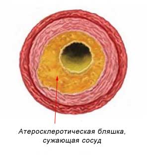 вторая стадия атеросклероза - образование холестериновой бляшки