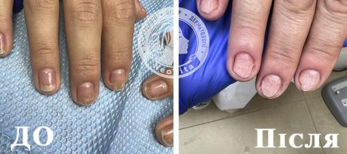Лечение химического ожога ногтей. Грибок ногтей: опасность лечения вслепую + эксклюзивные фотоматериалы по теме