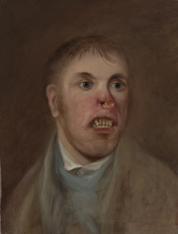 A young man, J. Kay, afflicted with a rodent disease