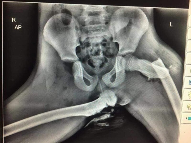 Ужасающий рентгеновский снимок показывает, почему не стоит класть ноги на переднюю панель безопасности, может, сломала, подушки, столкновении, девушка, аварии, наверняка, показаны, пришёлся, которую, правая, пострадала, основном, снимкеВ, рентгеновском, носПоследствия, небольшой, Печальная, коленкой