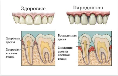 Как не растерять здоровые зубы, и почему нельзя запускать пародонтоз? Причины, простые советы по оздоровлению десны,здоровье,парадонтоз