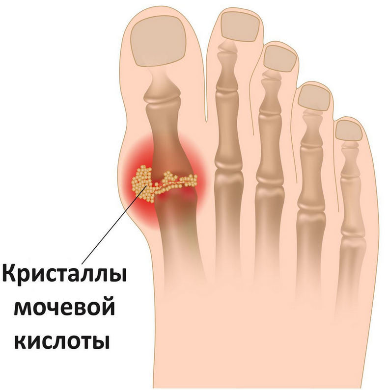 Подагра: что можно и чего нельзя есть здоровье и питание,подагра