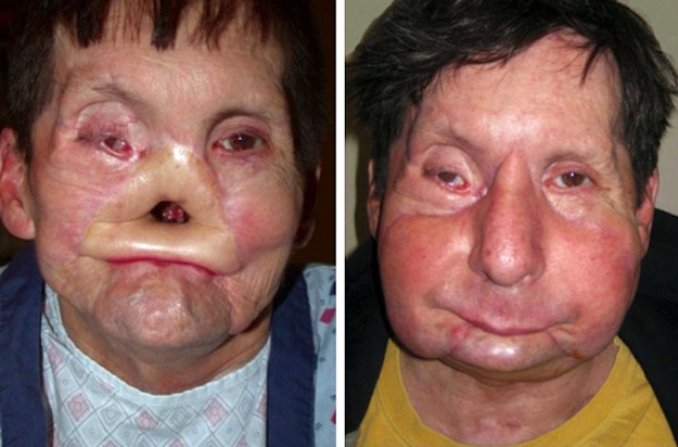 https://fshoke.com/wp-content/uploads/2012/02/James_Maki_face_transplantation.jpg