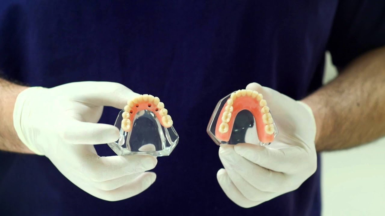 Какие бывают «вставные зубы»