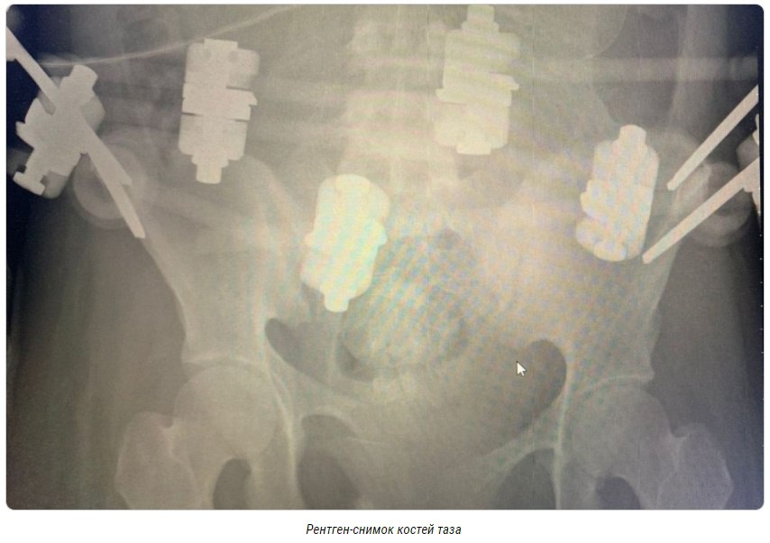 В декабре 2022 года пациентку с черепно-мозговой травмой, с оскольчатым переломом крестца и правой лонной кости со смещением экстренно доставили в Калининградскую областную больницу в состоянии комы. На тот момент она была в положении — срок беременности составлял 20 недель. В Калининграде врачи выполнили операцию по восстановлению тазовых костей с имплантацией спиц. Но у пациентки развилась пневмония.