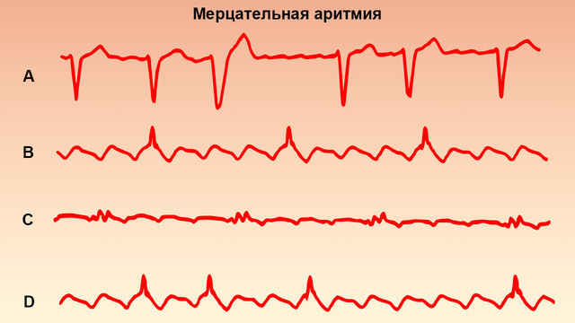 Мерцательная аритмия: причины, симптомы, лечение, что надо делать сердца, аритмии, может, аритмия, развития, мерцательной, предсердий, образ, жизни, заболевания, через, ритма, сердце, которые, нарушение, сердечного, время, применением, вероятность, пациентов