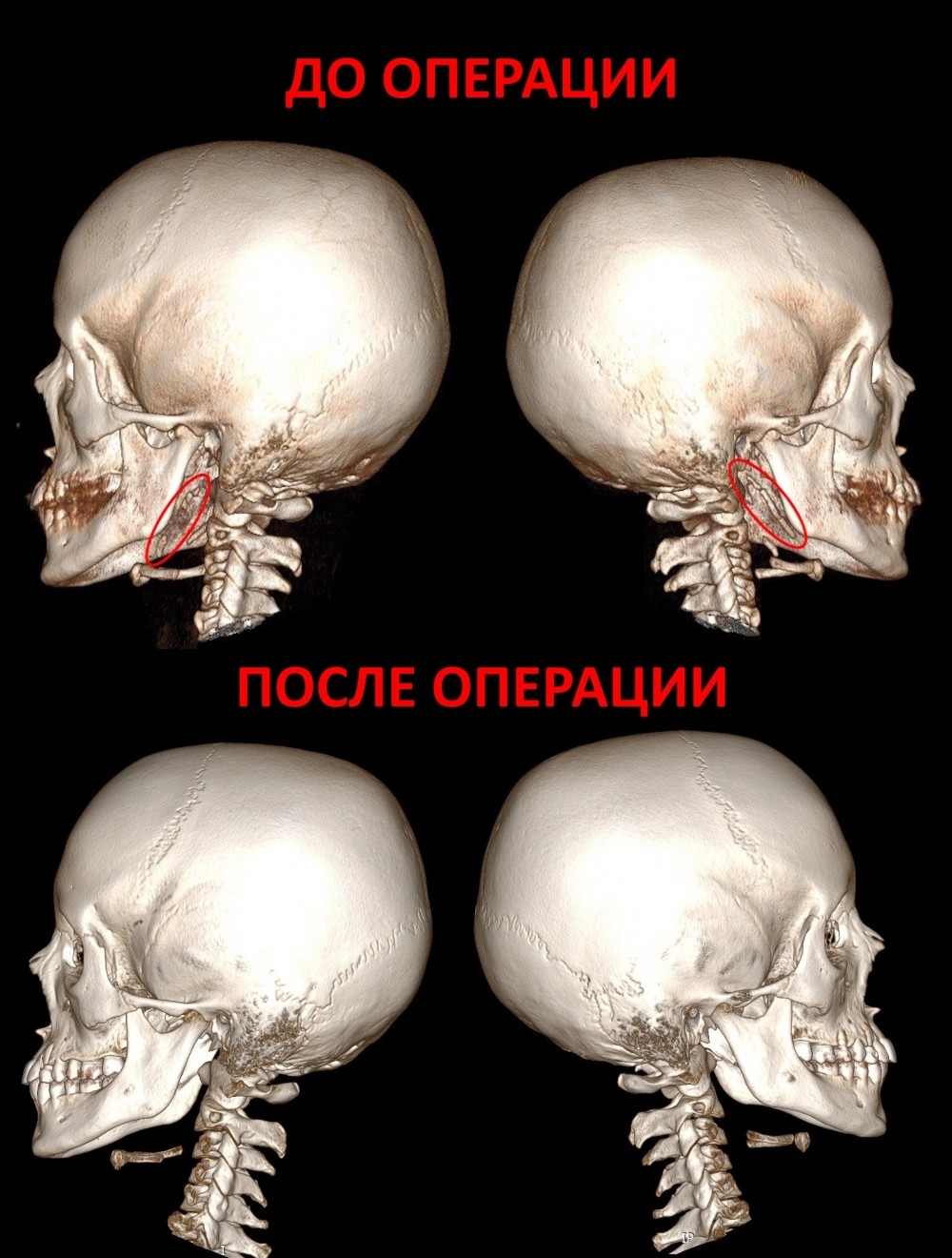 КТ-визуализация до и после операции.