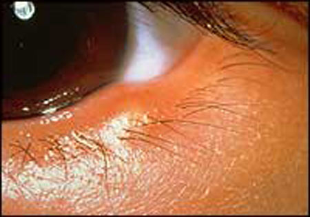 Ячмень глаза. Народные методы лечения ячменя и других заболеваний глаз