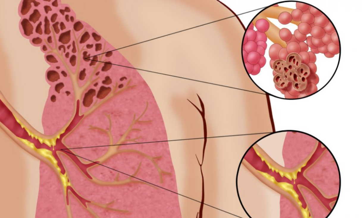 Отличные рецепты от хронического бронхита: из тетради врача