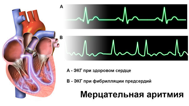 Мерцательная аритмия: причины, симптомы, лечение, что надо делать сердца, аритмии, может, аритмия, развития, мерцательной, предсердий, образ, жизни, заболевания, через, ритма, сердце, которые, нарушение, сердечного, время, применением, вероятность, пациентов