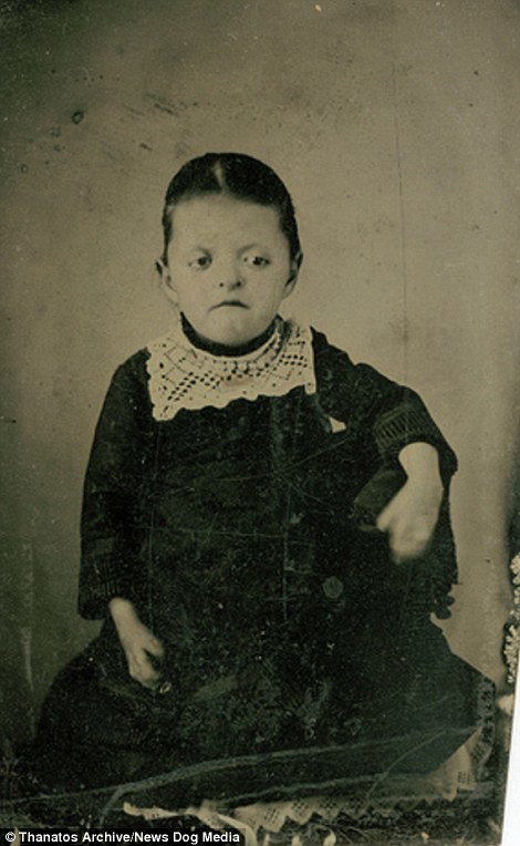 Очевидно, у девочки синдром Аперта. Фотография была сделана в 1870-х, однако болезнь впервые описали лишь в 1906 году деформация, люди
