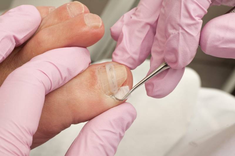 Грибок под ногтем: возможные причины, симптомы, проведение диагностических исследований, врачебное наблюдение и лечение