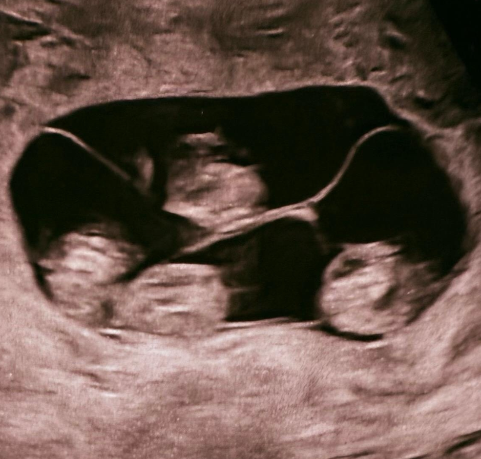 Впервые в России: в Петербурге женщина родила четверых близнецов более, беременность —, случаев, очень, беременности, развитие, эмбрионов, четверни —, всегда, общей, случай, плаценты, похожи, такие, недели, однояйцевой, родильного, сестры, девочкиТакже, двойняшки