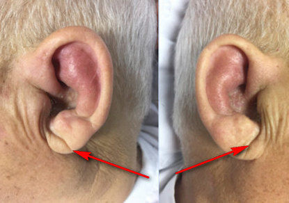 Картинки по запросу складка на мочке уха может предсказать инсульт - израильские ученые