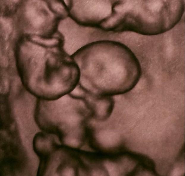 Впервые в России: в Петербурге женщина родила четверых близнецов более, беременность —, случаев, очень, беременности, развитие, эмбрионов, четверни —, всегда, общей, случай, плаценты, похожи, такие, недели, однояйцевой, родильного, сестры, девочкиТакже, двойняшки