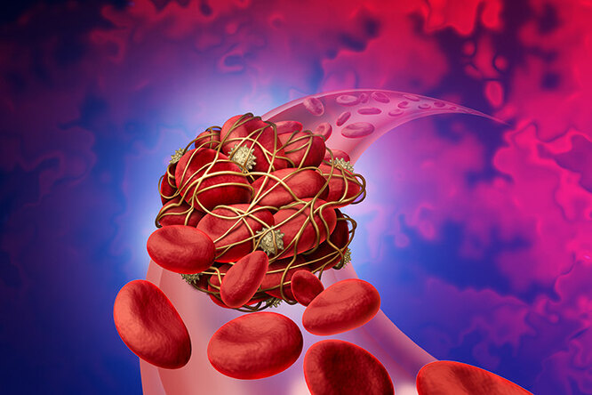 Невидимые и смертельно опасные: как понять, что у тебя есть тромбы здоровье,инсульт,инфаркт,кровь и сосуды