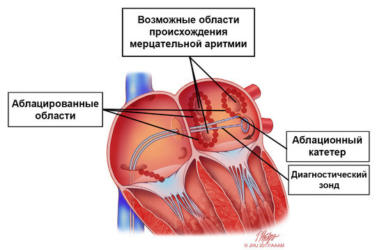 Мерцательная аритмия: причины, симптомы, лечение, что надо делать сердца, аритмии, может, аритмия, развития, мерцательной, предсердий, образ, жизни, заболевания, через, ритма, сердце, которые, нарушение, сердечного, время, применением, вероятность, пациентов